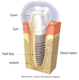 Gentle tooth extraction